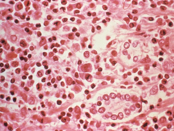 Fatal Outbreak: Hantavirus Claims Three Lives on Atlantic Cruise