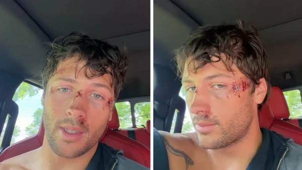 ‘Traitors’ Winner Rob Rausch Suffers Gnarly Injuries After Bike Collides with Dog